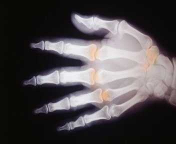 RADIOGRAFIA MANO · IMAGENES FOTOS